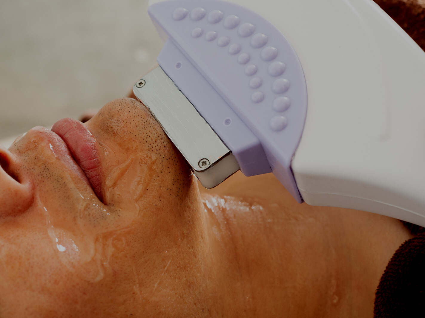 A man undergoing beard hair removal treatment on the jaw